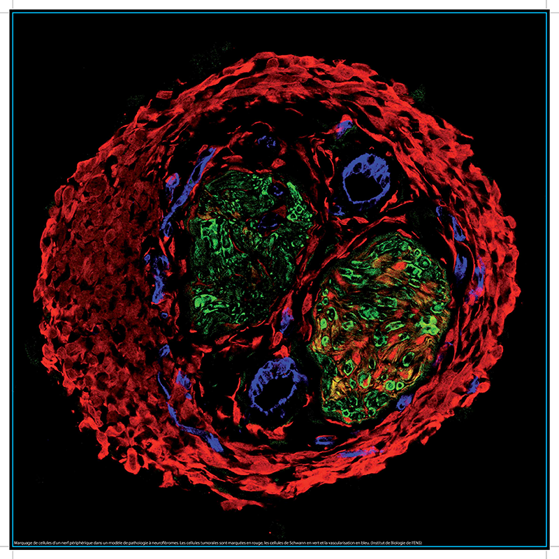 Marquage de cellules d'un nerf périphérique dans un modèle de pathologie à neurofibromes. Les cellules tumorales sont marquées en rouge, les cellules de Schwann en vert et la vascularisation en bleu.